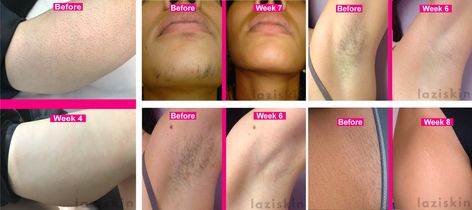 Laziskin IPL Hair Removal results